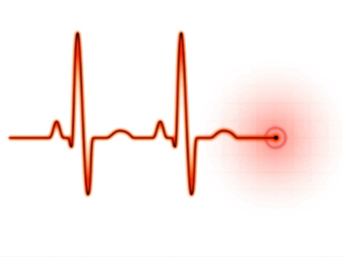 365/17 - 140 - EKG